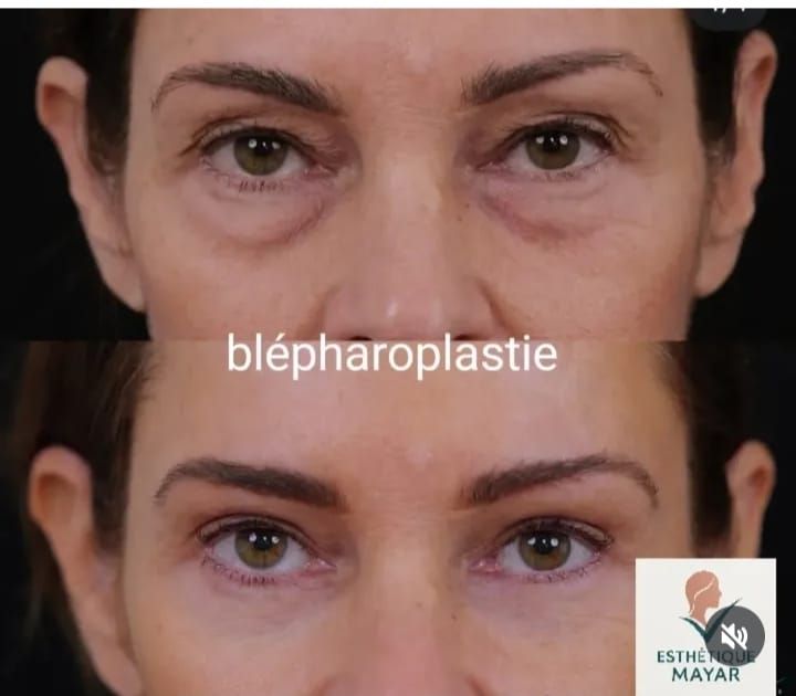 Avant / après — Blépharoplastie