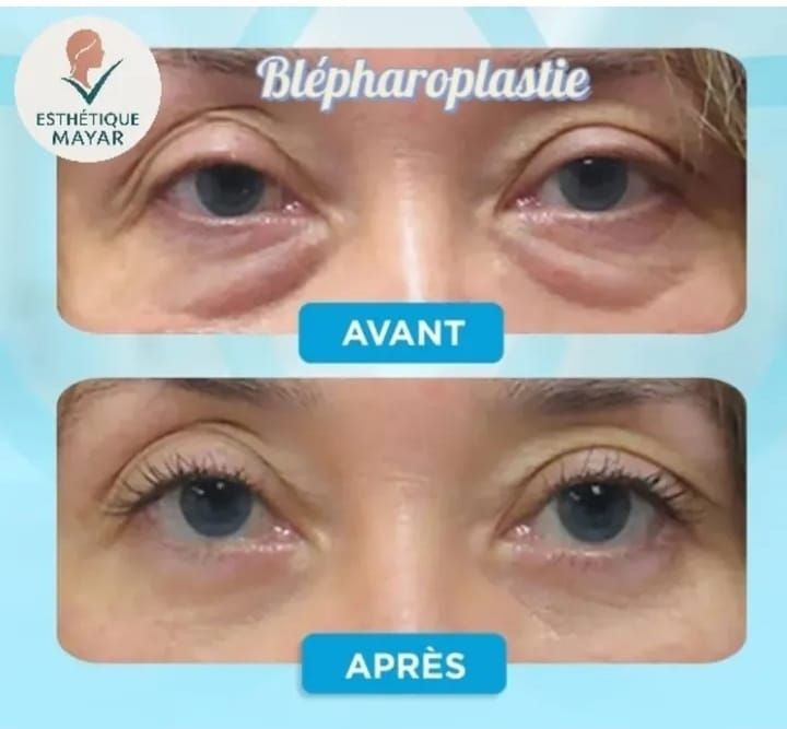 Blépharoplastie