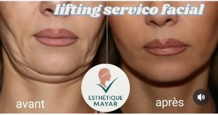 Lifting cervical