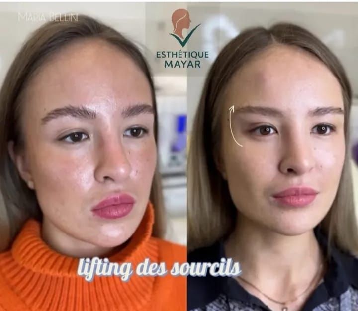 Lifting du visage