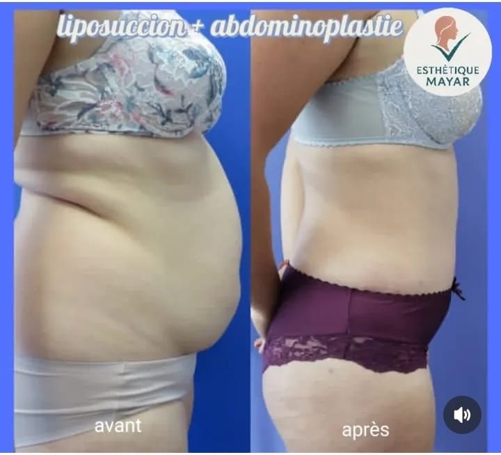 Avant / après — Liposuccion + Abdominoplastie