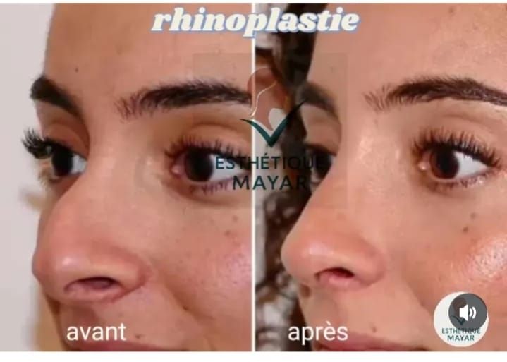 Rhinoplastie