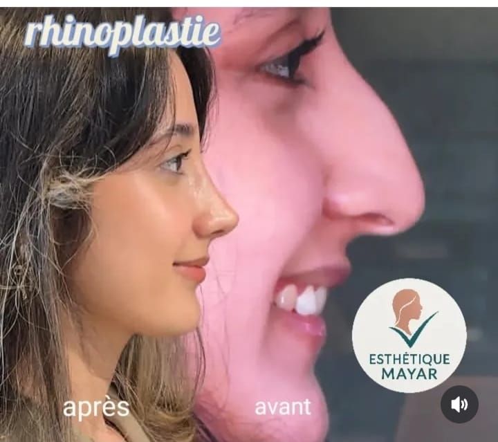 Avant / après — Rhinoplastie