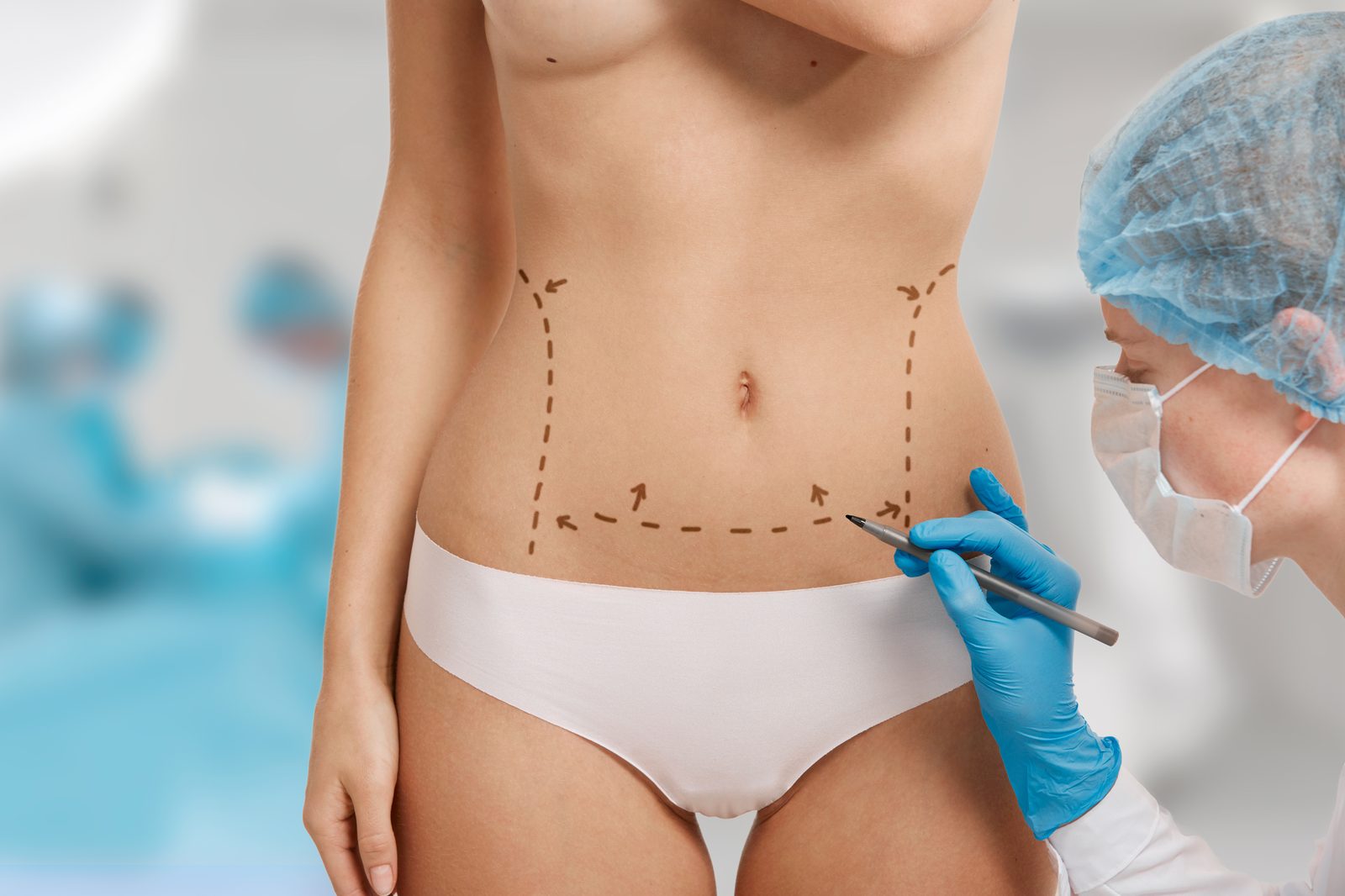 Mini-abdominoplastie
