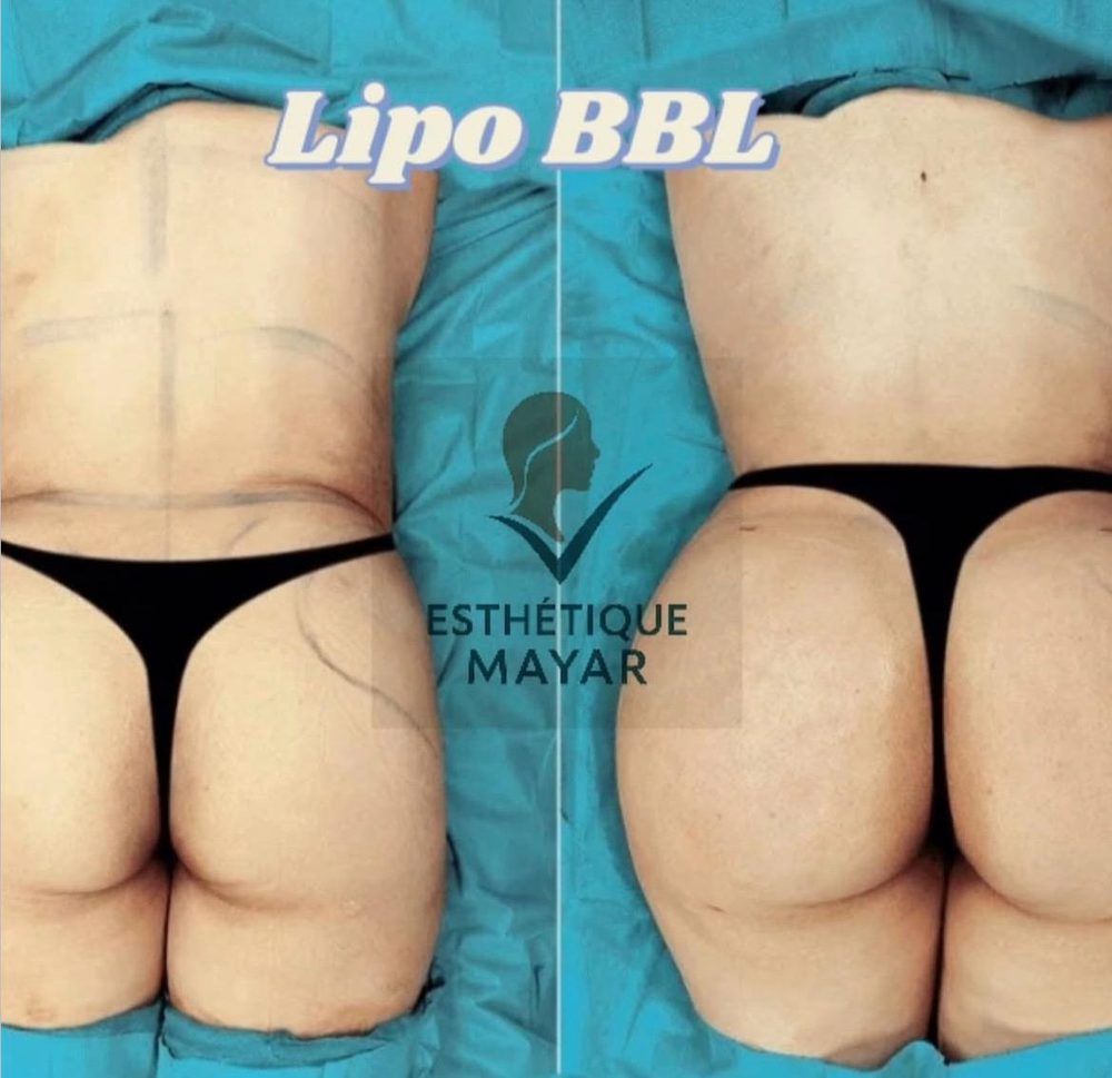 Lipo BBL : avant et après, vue de dos