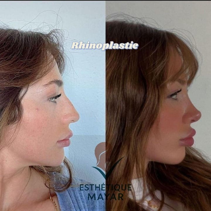 Rhinoplastie : profil avant et après